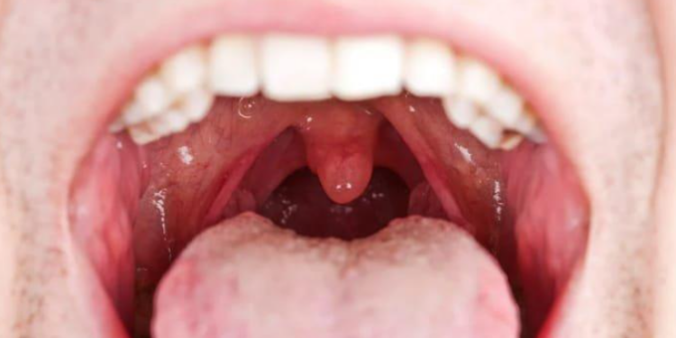 Apakah Menelan Ludah Bercampur Darah Membatalkan Puasa? Ini Penjelasannya